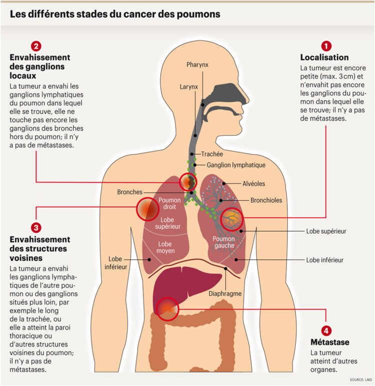 Les différents stades du cancer des poumons