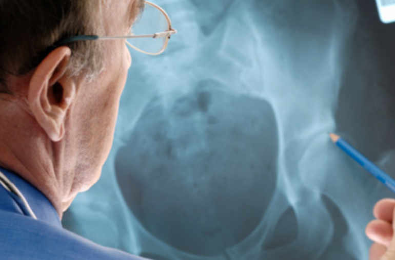 Ostéoporose: état de la recherche en 2013