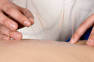 De l’acupuncture avant l’opération?