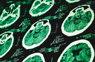 Maladie d’Alzheimer: une transmission interhumaine possible?