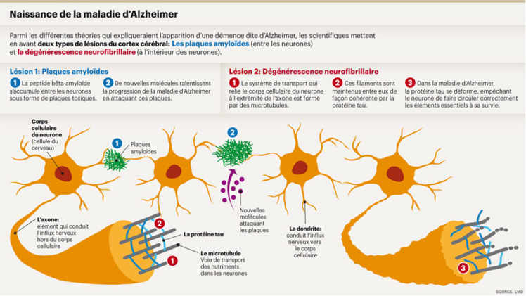 Naissance de la maladie d'Alzheimer