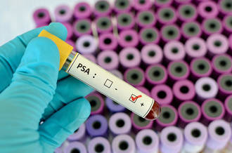 Cancer de la prostate, faut-il se méfier du dépistage?