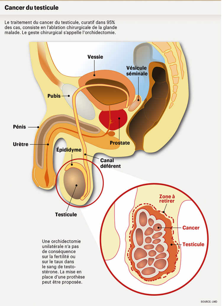 Le cancer des testicules reste rare, mais il progresse - Planete sante