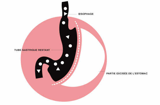 Gastrectomie tubulisée