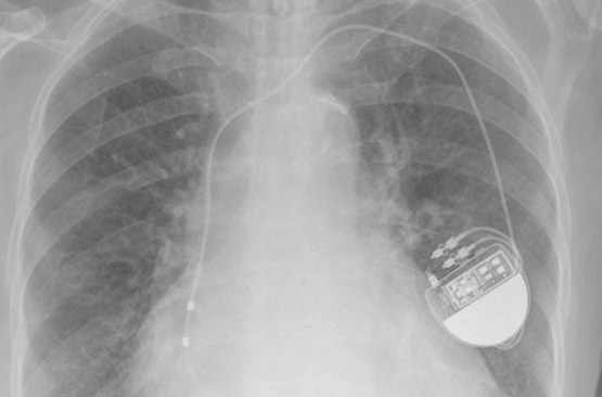 Le boîtier du pacemaker est placé en haut de la poitrine
