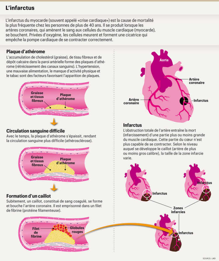 L'infarctus