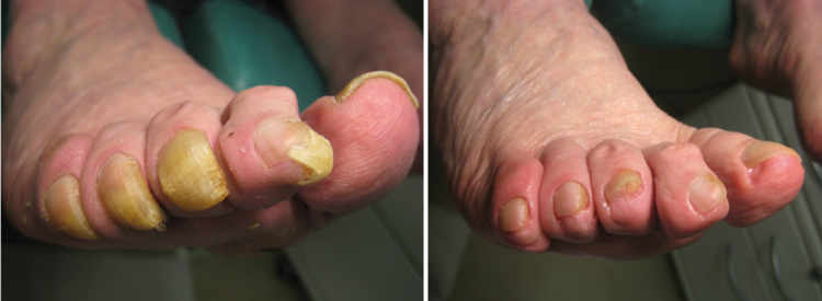 Ongles pathologiques des pieds