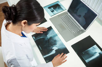 Prothèses: augmentation du nombre de fractures