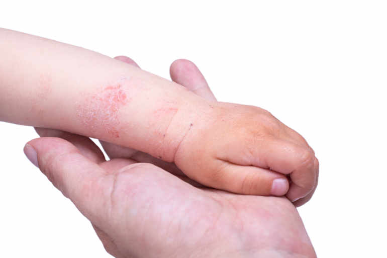 semne ale piciorului varicos tratamentul morcovilor varicoza