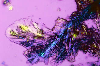 Cristaux de cisplatine utilisé en chimiothérapie