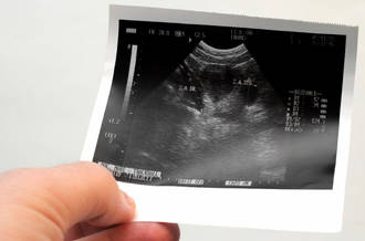 Bientôt un dépistage systématique du cancer de l’ovaire?