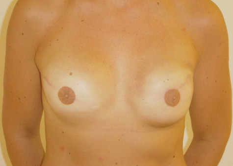 Reconstruction des deux seins par prothèse 