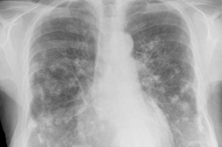 Radiographie pulmonaire