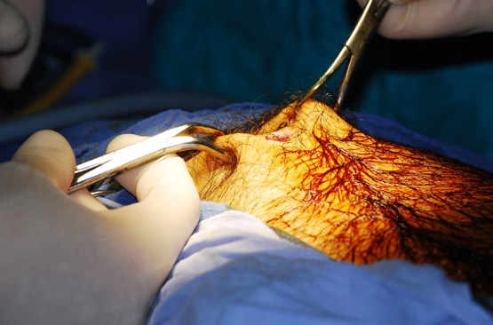 Préparation d'une opération de la vésicule biliaire