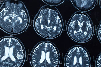 Cap sur les nouvelles applications de la stimulation cérébrale profonde