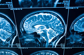 AVC: aider le cerveau à mieux récupérer