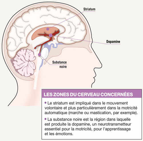 Infographie parkinson
