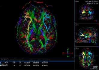L’imagination pour surmonter les séquelles d’un AVC
