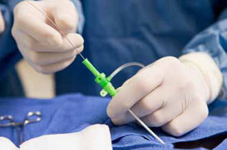 La dénervation rénale pour lutter contre l’hypertension