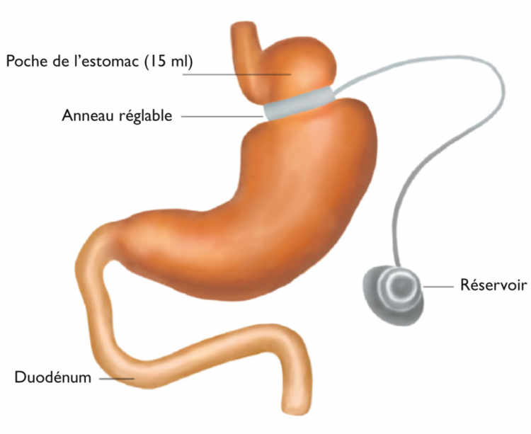 Figure 1. Cerclage gastrique (CG)