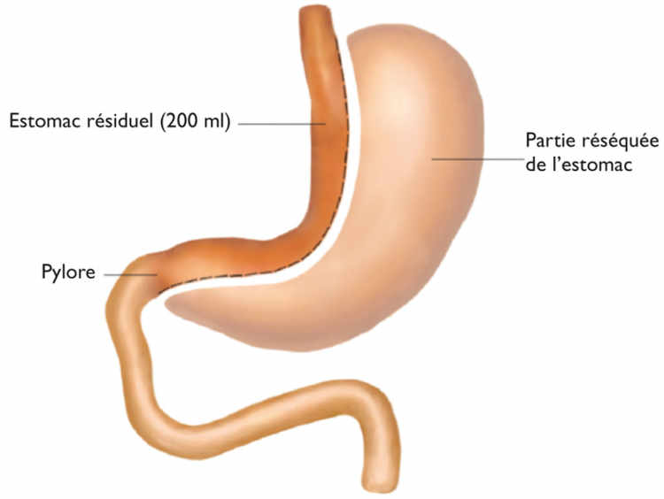 Figure 2. Sleeve gastrectomy (gastrectomie en ­manchon) (SG)