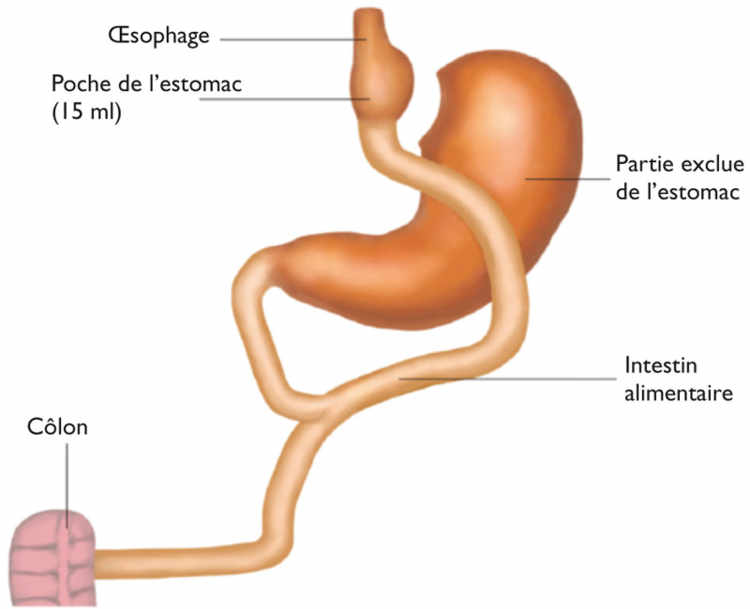 Figure 3. Bypass gastrique proximal avec anse en Y (BPG)