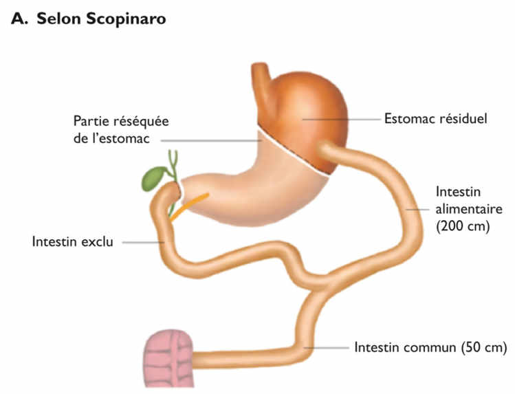 Figure 4. Dérivations bilio-pancréatiques (BPD)