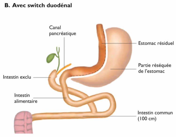 Figure 4. Dérivations bilio-pancréatiques (BPD)