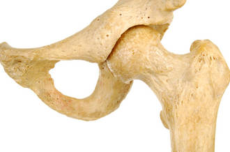 protèse de la hanche