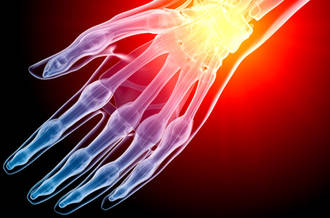 syndrome douloureux régional complexe (SDRC)