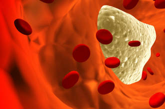 Caillot dans un vaisseau sanguin