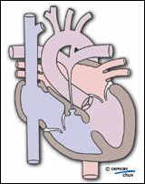 schéma illustrant l'atrésie de l'artère pulmonaire