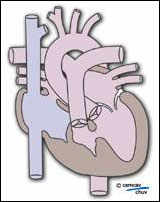 Image illustrant le coeur avec atrésie de la valve tricuspide