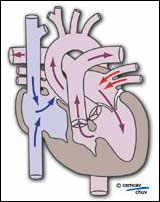 Image illustrant le sens du sang dans un coeur avec atrésie tricuspide