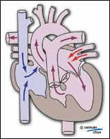 Image illustrant le sens du sang dans un coeur avec atrésie tricuspide