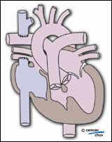 schéma d'un coeur après la première phase d'une correction chirurgical d'une atrésie tricuspide