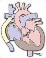Schéma d'un coeur après chirurgie correctrice d'une valve tricuspide atrésiée