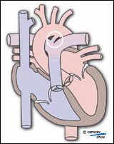 Image illustrant un coeur avec canal artériel perméable