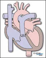 Illustration d'un coeur après traitement chirurgical
