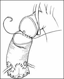 Dessin d'une intervention de Bentall avec remplacement de la valve aortique, de l’aorte ascendante et ré-implantation des ostia coronariens