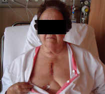 Femme exhibant son thorax après une mini-sternotomie