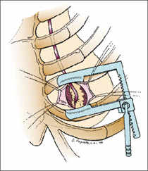 Exemple de mini-thoracotomie latérale gauche