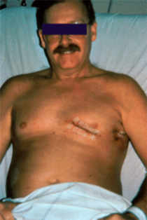 Résultat après mini-thoracotomie latérale gauche