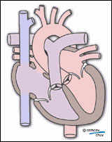 Schéma d'une communication du septum inter-auriculaire (CIA)