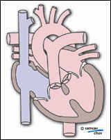 Schéma montrant la communication inter-ventriculaire (CIV)