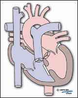 Schéma d'un coeur avec une CIV après un traitement chirurgical   