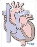 Schéma d'un coeur avec coartation aortique après la gerbe aortique