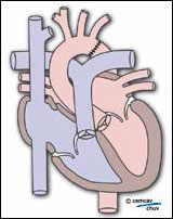Schéma montrant le coeur et ses vaisseaux après correction chirurgicale de la coarctation aortique   