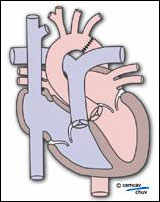 Schéma montrant le coeur et ses vaisseaux après correction chirurgicale de la coarctation aortique   