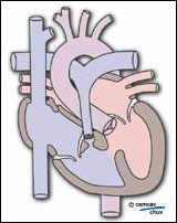 Schéma d'un coeur avec tétralogie de fallot